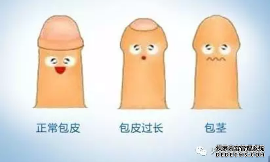 马鞍山男科医院：哪种包皮过长不用割？