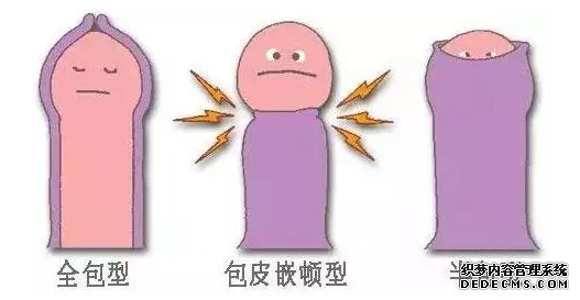 马鞍山我这是包皮过长还是包茎？该怎么办？