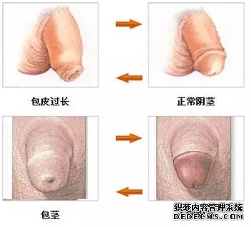 马鞍山包皮过长会影响男性性功能吗