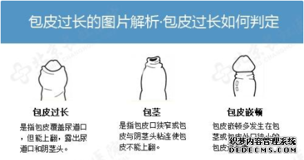 马鞍山包茎包皮过长对男性身心健康的危害