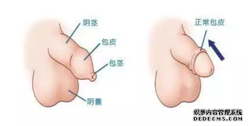 马鞍山和县通过哪几点可以判断男人是不是包皮过长?