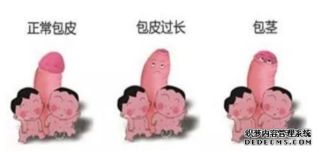 马鞍山怎样才算是包皮过长?包皮过长需要手术吗?